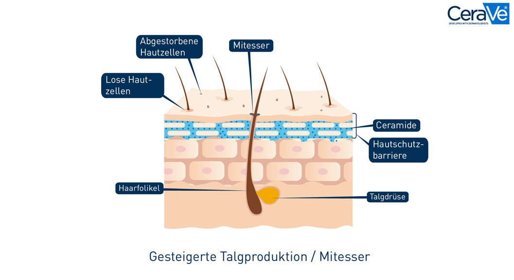Grafik mit dem Aufbau einer unreinen, zu Akne neigenden Haut